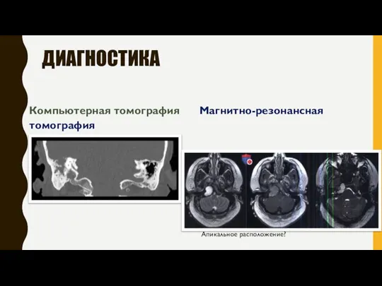 ДИАГНОСТИКА Компьютерная томография Магнитно-резонансная томография Апикальное расположение?