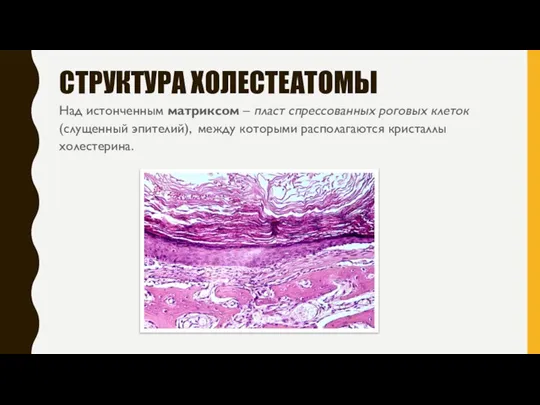 СТРУКТУРА ХОЛЕСТЕАТОМЫ Над истонченным матриксом – пласт спрессованных роговых клеток (слущенный эпителий),