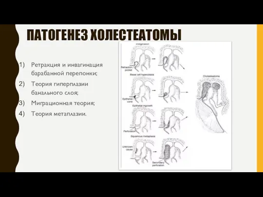 ПАТОГЕНЕЗ ХОЛЕСТЕАТОМЫ Ретракция и инвагинация барабанной перепонки; Теория гиперплазии банального слоя; Миграционная теория; Теория метаплазии.