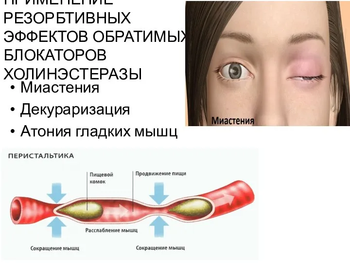 ПРИМЕНЕНИЕ РЕЗОРБТИВНЫХ ЭФФЕКТОВ ОБРАТИМЫХ БЛОКАТОРОВ ХОЛИНЭСТЕРАЗЫ Миастения Декураризация Атония гладких мышц