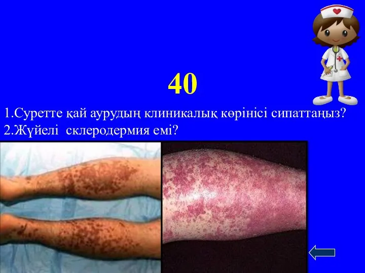 40 1.Суретте қай аурудың клиникалық көрінісі сипаттаңыз? 2.Жүйелі склеродермия емі? www.ZHARAR.com