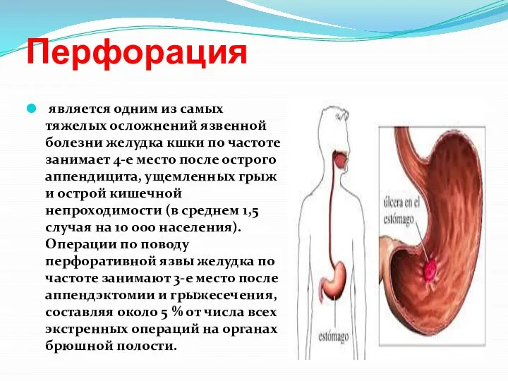 Перфорация является одним из самых тяжелых осложнений язвенной болезни желудка кшки по