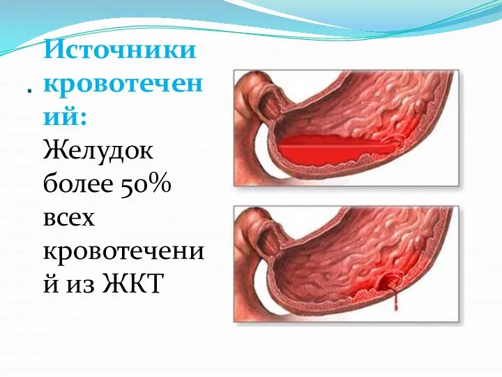 . Источники кровотечений: Желудок более 50% всех кровотечений из ЖКТ