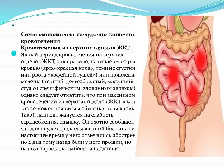 . . Симптомокомплекс желудочно-кишечного кровотечения Кровотечения из верхних отделов ЖКТ Явный период