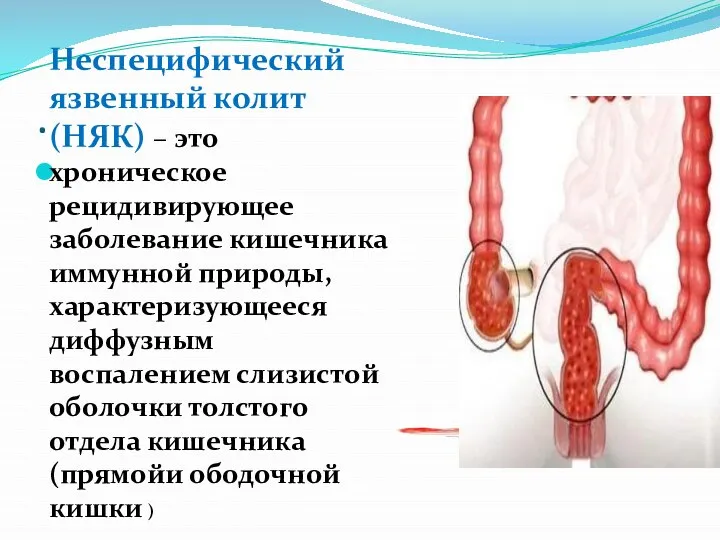 . . Неспецифический язвенный колит (НЯК) – это хроническое рецидивирующее заболевание кишечника