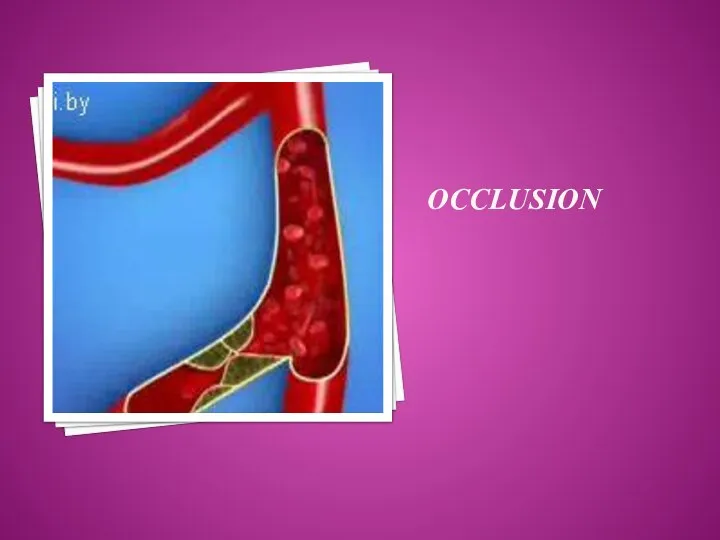 OCCLUSION