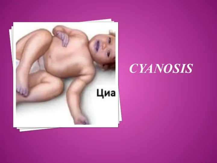 CYANOSIS