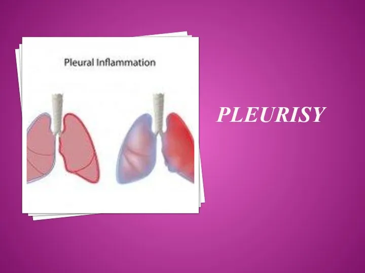 PLEURISY