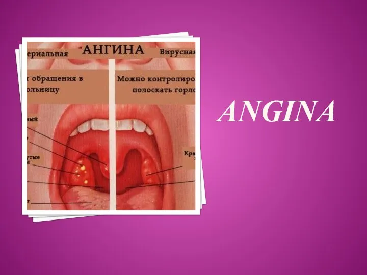 ANGINA