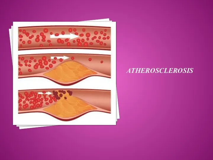 ATHEROSCLEROSIS