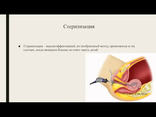 Стерилизация Стерилизация – высокоэффективный, но необратимый метод, применяется в тех случаях, когда