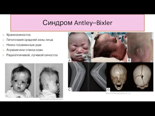 Синдром Antley–Bixler DOI:10.1007/s003810050082 Краниосиностоз Гипоплазия средней зоны лица Низко посаженные уши Атрезия