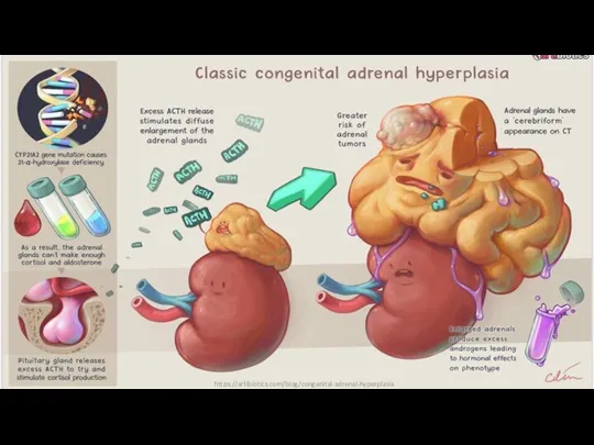 https://artibiotics.com/blog/congenital-adrenal-hyperplasia