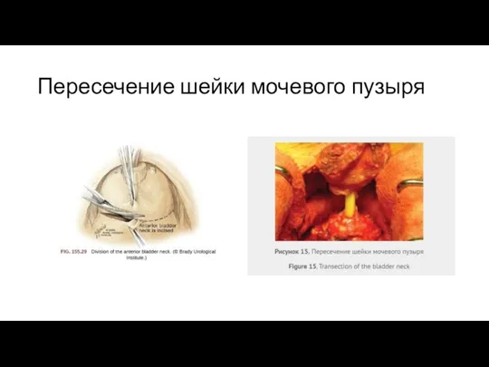 Пересечение шейки мочевого пузыря