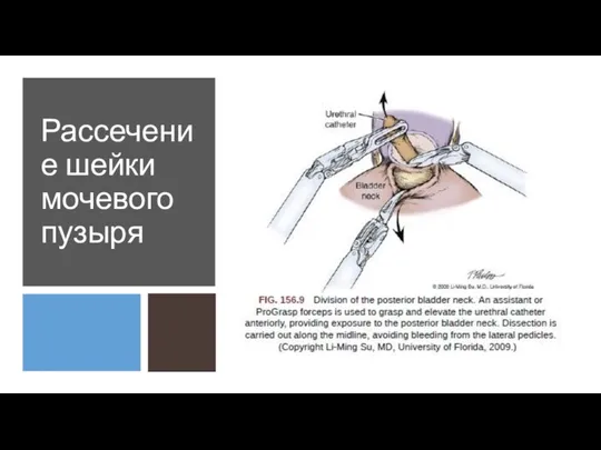 Рассечение шейки мочевого пузыря