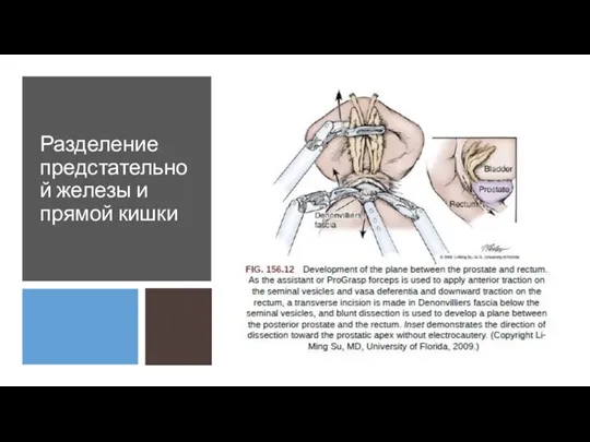 Разделение предстательной железы и прямой кишки