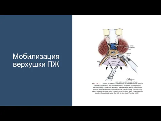 Мобилизация верхушки ПЖ