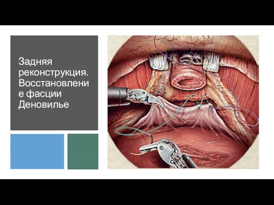 Задняя реконструкция. Восстановление фасции Деновилье