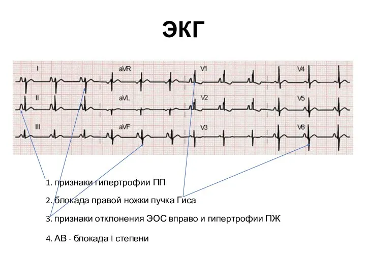 ЭКГ 1. признаки гипертрофии ПП 2. блокада правой ножки пучка Гиса 3.