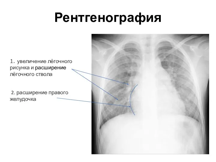 Рентгенография 2. расширение правого желудочка 1. увеличение лёгочного рисунка и расширение лёгочного ствола