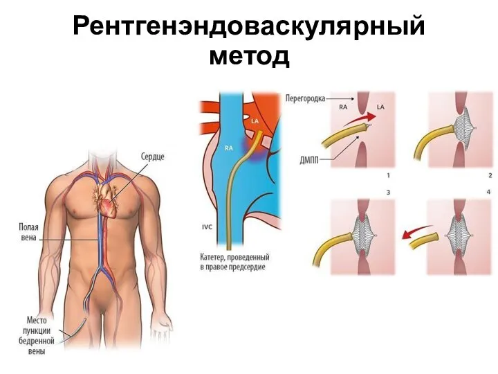 Рентгенэндоваскулярный метод