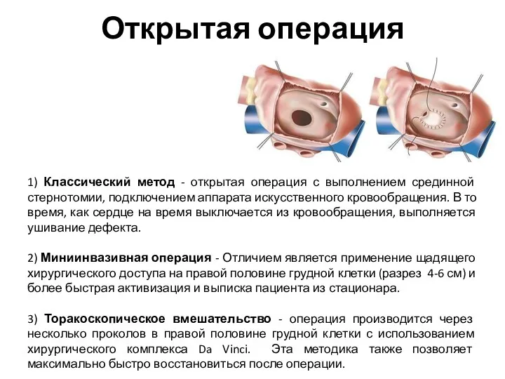 1) Классический метод - открытая операция с выполнением срединной стернотомии, подключением аппарата