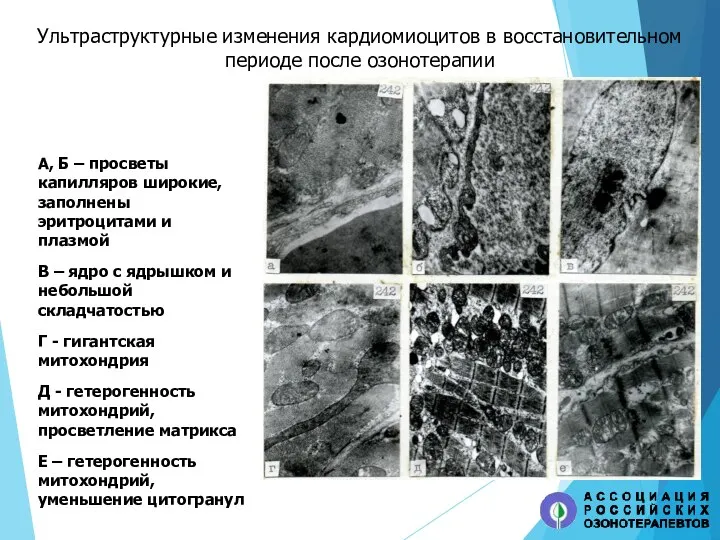 Ультраструктурные изменения кардиомиоцитов в восстановительном периоде после озонотерапии А, Б – просветы