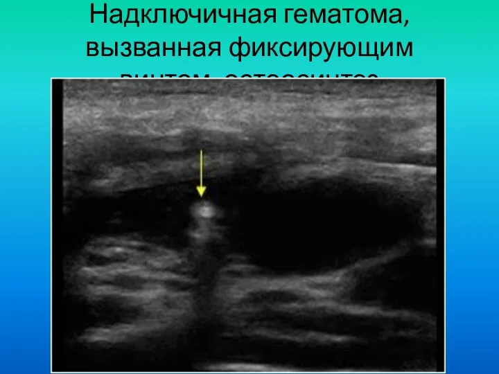 Надключичная гематома, вызванная фиксирующим винтом, остеосинтез