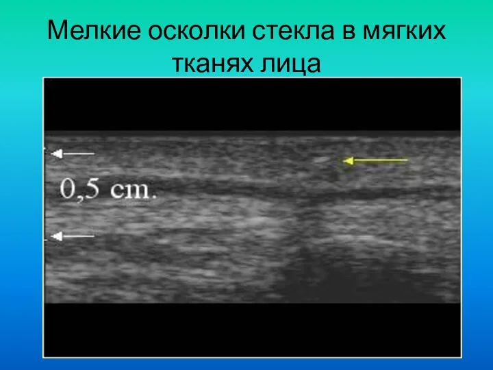 Мелкие осколки стекла в мягких тканях лица