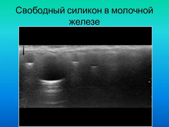 Свободный силикон в молочной железе