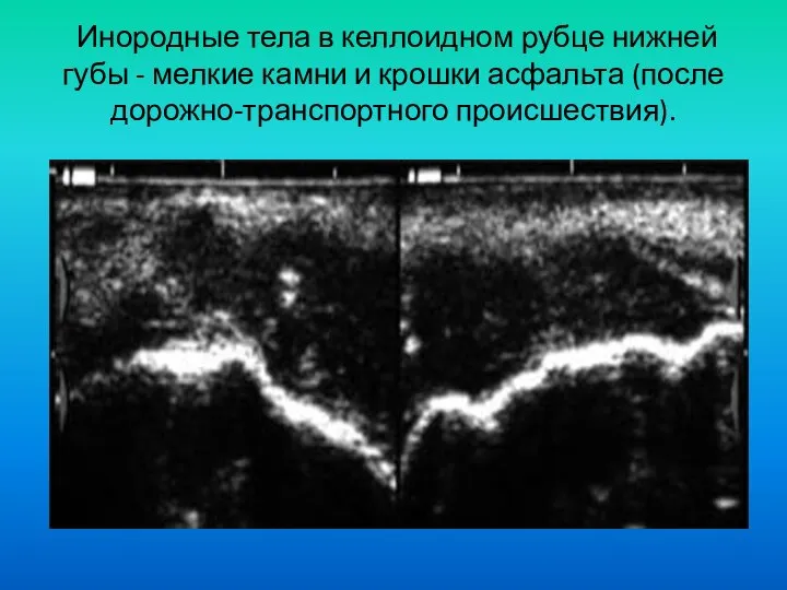 Инородные тела в келлоидном рубце нижней губы - мелкие камни и крошки асфальта (после дорожно-транспортного происшествия).