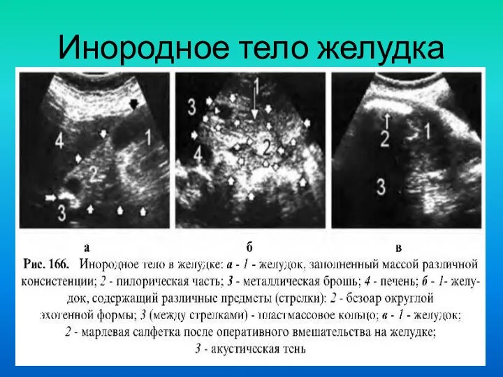 Инородное тело желудка