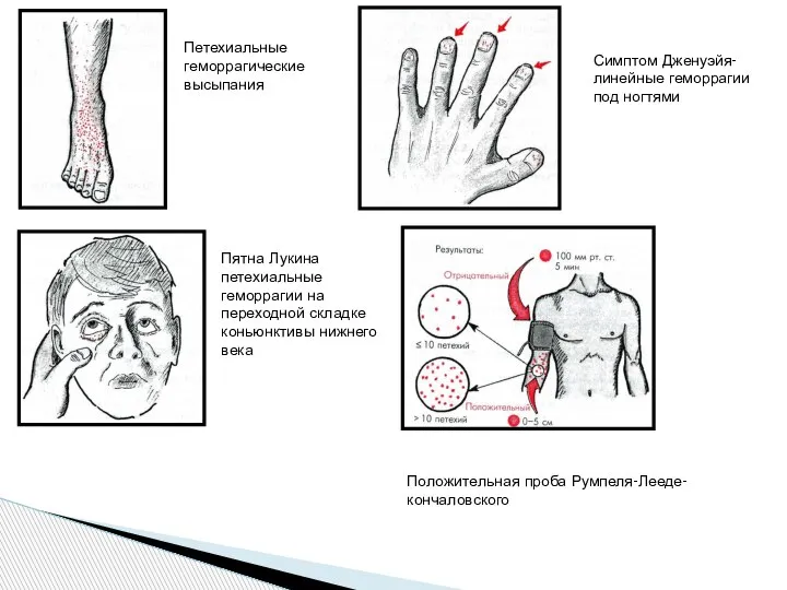 Петехиальные геморрагические высыпания Пятна Лукина петехиальные геморрагии на переходной складке коньюнктивы нижнего