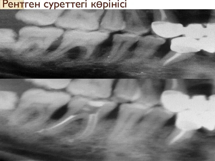 Рентген суреттегі көрінісі