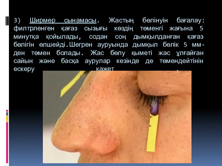 3) Ширмер сынамасы. Жастың бөлінуін бағалау:филтрленген қағаз сызығы көздің төменгі жағына 5