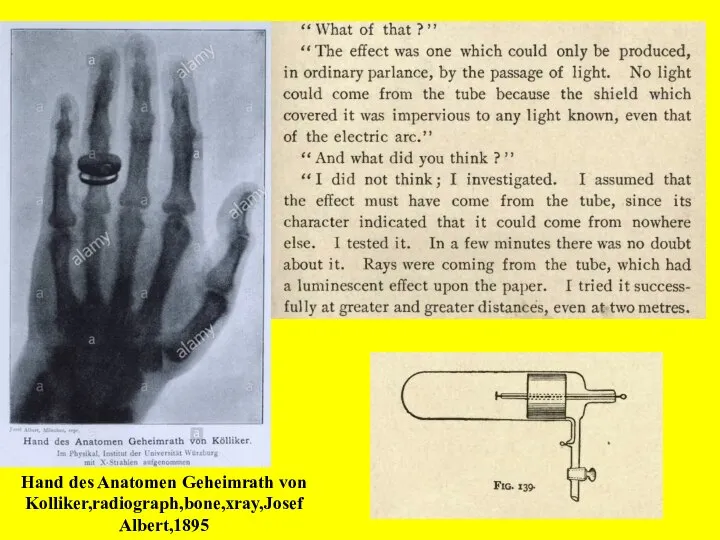 Hand des Anatomen Geheimrath von Kolliker,radiograph,bone,xray,Josef Albert,1895