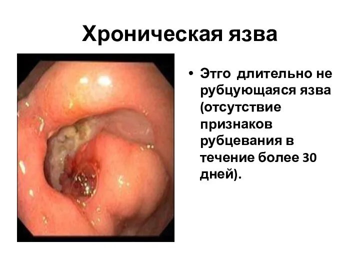 Хроническая язва Этго длительно не рубцующаяся язва (отсутствие признаков рубцевания в течение более 30 дней).