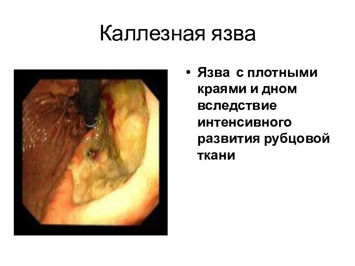 Каллезная язва Язва с плотными краями и дном вследствие интенсивного развития рубцовой ткани