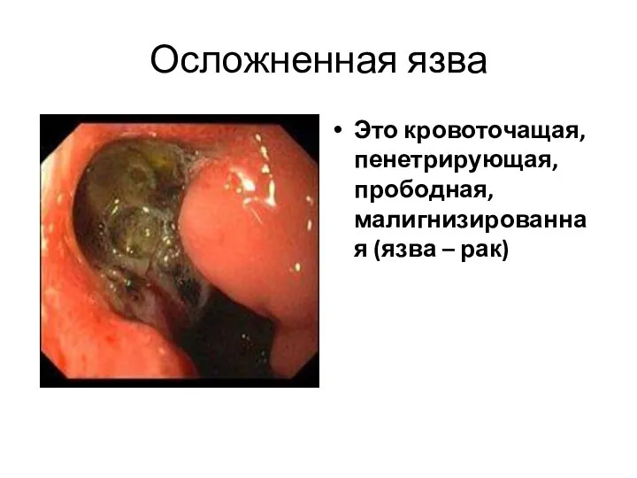 Осложненная язва Это кровоточащая, пенетрирующая, прободная, малигнизированная (язва – рак)