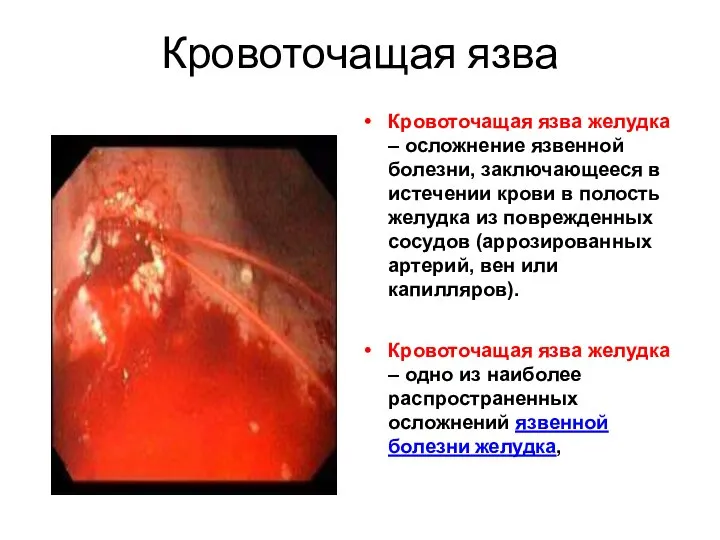 Кровоточащая язва Кровоточащая язва желудка – осложнение язвенной болезни, заключающееся в истечении