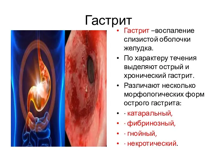 Гастрит Гастрит –воспаление слизистой оболочки желудка. По характеру течения выделяют острый и