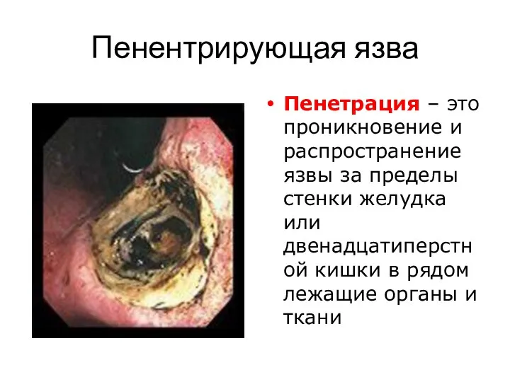 Пенентрирующая язва Пенетрация – это проникновение и распространение язвы за пределы стенки