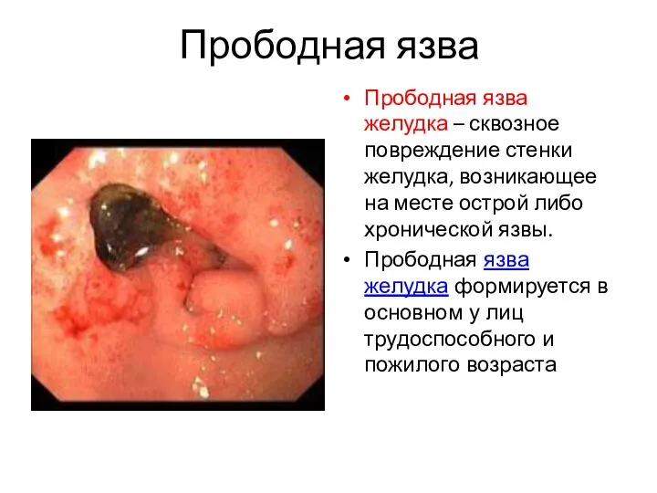 Прободная язва Прободная язва желудка – сквозное повреждение стенки желудка, возникающее на