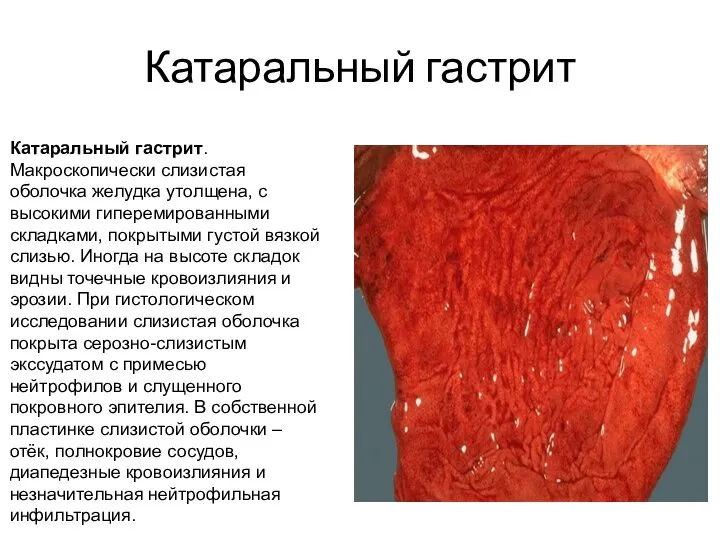 Катаральный гастрит Катаральный гастрит.Макроскопически слизистая оболочка желудка утолщена, с высокими гиперемированными складками,