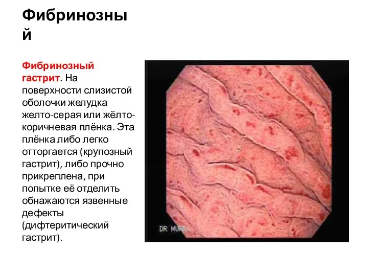 Фибринозный Фибринозный гастрит. На поверхности слизистой оболочки желудка желто-серая или жёлто-коричневая плёнка.