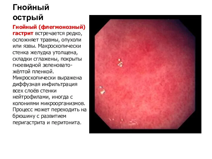 Гнойный острый Гнойный (флегмонозный) гастрит встречается редко, осложняет травмы, опухоли или язвы.