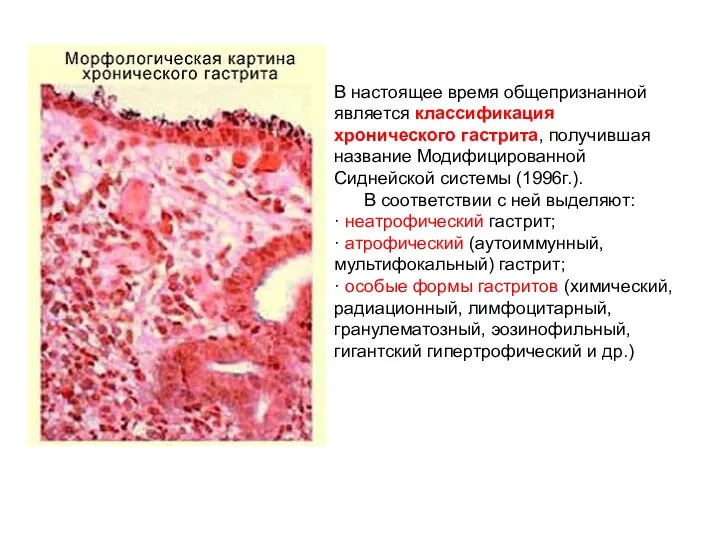 В настоящее время общепризнанной является классификация хронического гастрита, получившая название Модифицированной Сиднейской