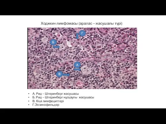 Ходжкин лимфомасы (аралас – жасушалы түрі) А. Рид – Штеринберг жасушасы Б.