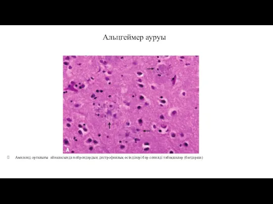 Альцгеймер ауруы Амилоид орталығы айналасында нейрондардың дистрофиялық өсінділері бар сенилді табақшалар (бағдарша)