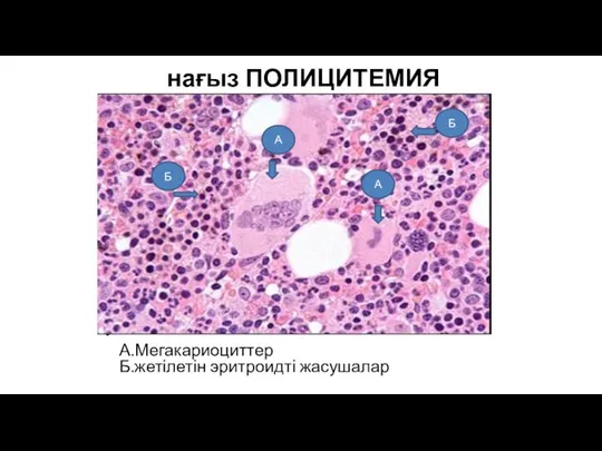 нағыз ПОЛИЦИТЕМИЯ А.Мегакариоциттер Б.жетілетін эритроидті жасушалар А А Б Б